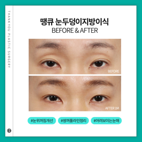 눈두덩이지방이식으로 피곤한 이미지 탈출! 생기있는 눈매 완성! 관련 이미지 9