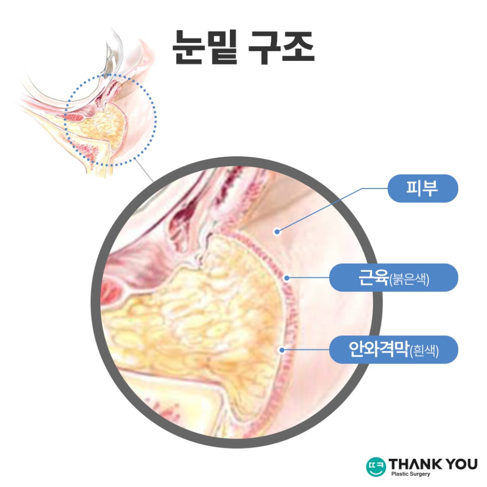 눈밑성형에 격막 강화란 무엇인가요? [눈밑지] 관련 이미지 4