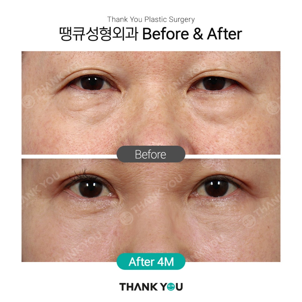 강남 눈밑지방재배치(전후 체크) THANY YOU이벤트 관련 이미지 14