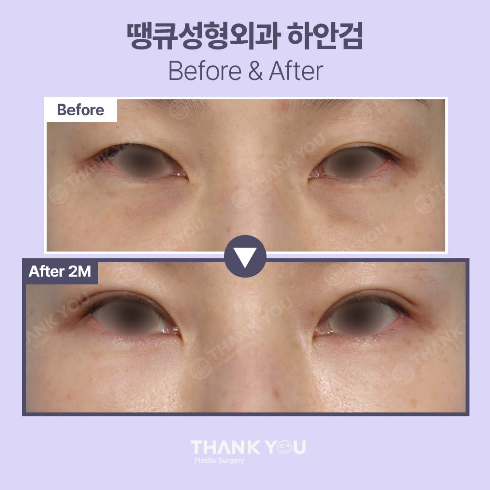 눈밑하안검수술 전후사진 확인, 땡큐 이호준 원장님 관련 이미지 8
