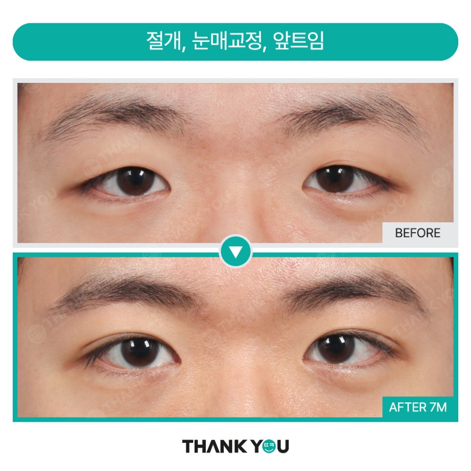 고양이 눈매 완성! (ft.눈매교정+앞,뒤,밑트임+눈밑지) 관련 이미지 18
