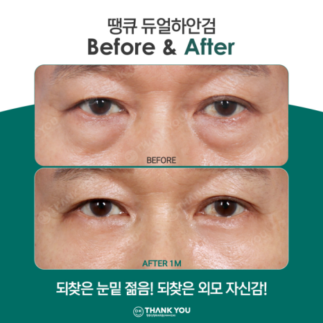 If You Want a Satisfying Difference Before and After Lower Blepharoplasty?! Thank You Dual Lower Blepharoplasty image 6