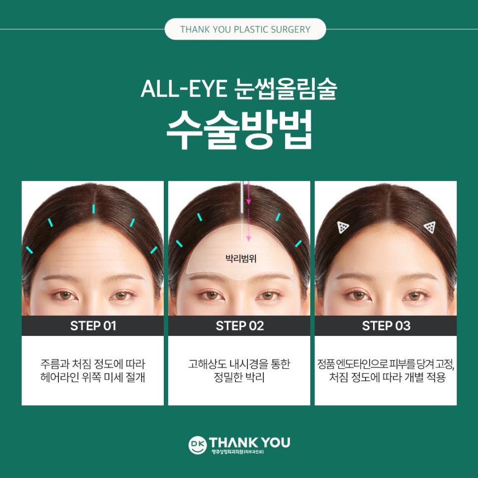 Improving Drooping, Tired-Looking Eyes in One Go with Forehead Lift Surgery! image 14
