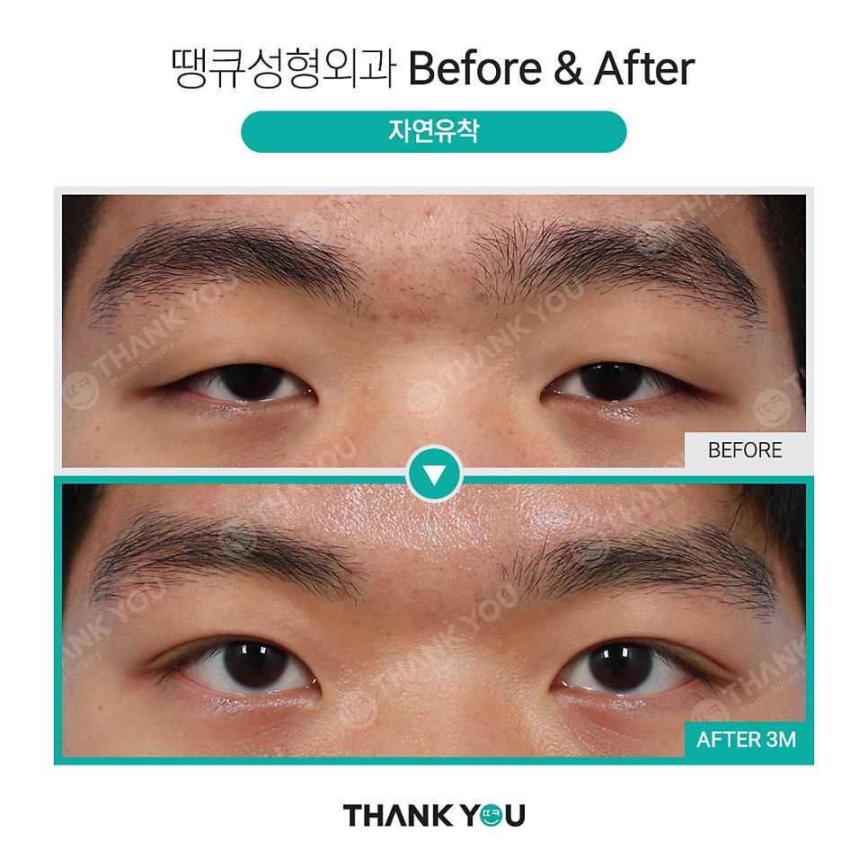 남자 쌍수 전후, 관련 이미지 1