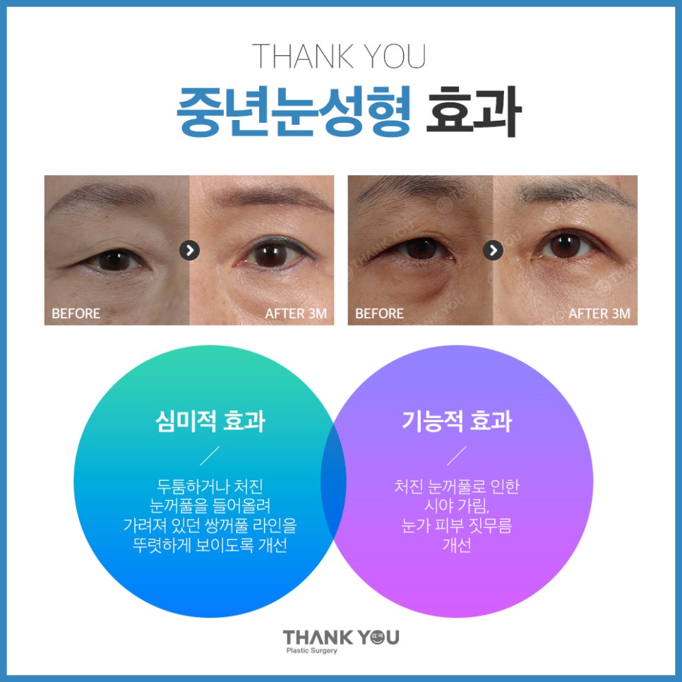 중년눈수술, 50대 60대 눈처짐과 눈꺼풀짓무름 해결법 관련 이미지 14