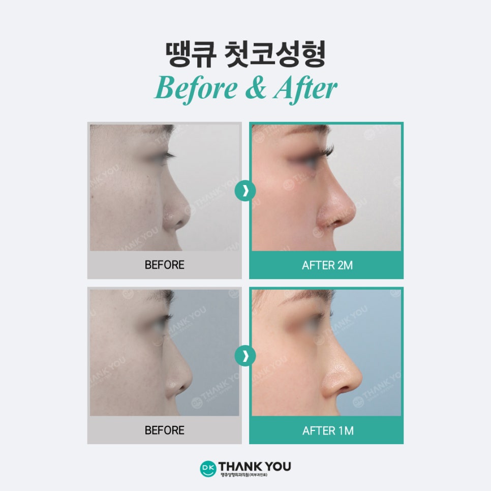 첫코성형 EVENT! 땡큐에서 자연스러운 콧대~코끝 라인 완성! 관련 이미지 5