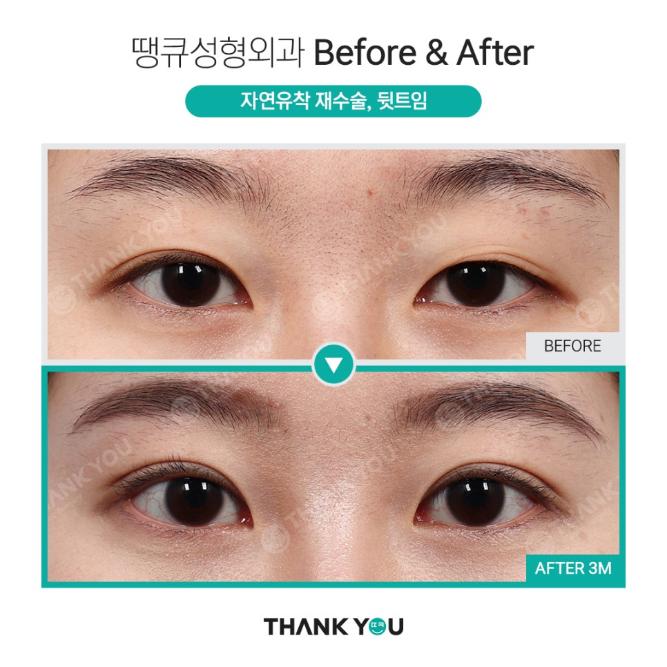 쌍수 뒷트임 (앞트임,밑트임, 듀얼트임 종류) 전후사진 관련 이미지 14