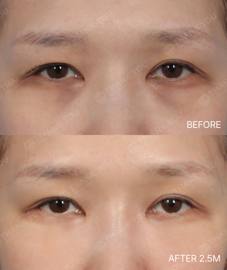 눈밑지방재배치 앞광대 지방이식이 필요한 이유? 관련 이미지 10