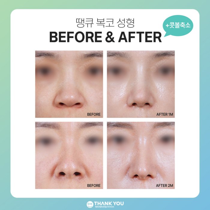 복코성형 전후, 명확한 차이를 만들고 싶다면?! 관련 이미지 9