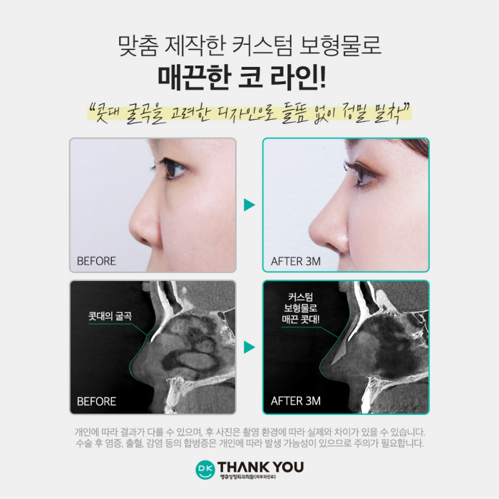 Natural-Looking Rhinoplasty with a Custom Implant That Fits Like My Original Nose! image 3