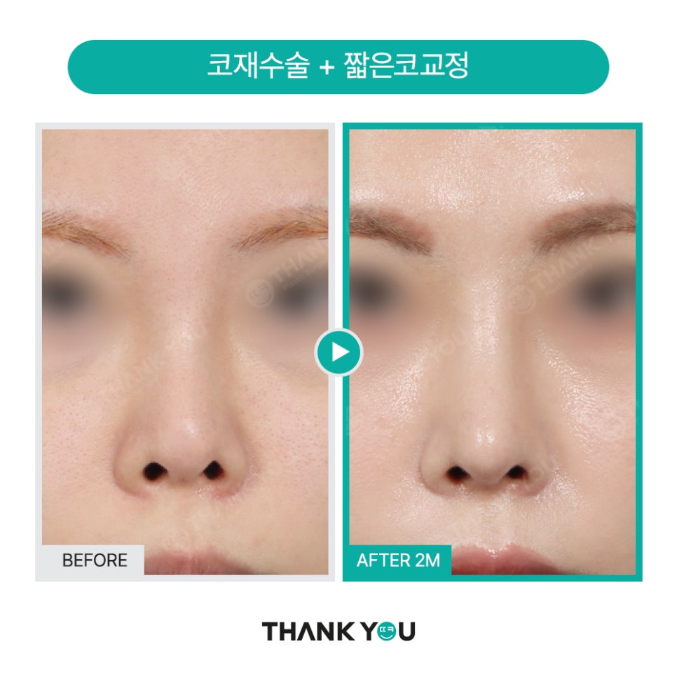 자가늑연골 코수술 장단점, 실리콘없이 무보형물 전후Check 관련 이미지 19