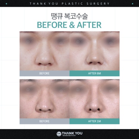 A Great Bulbous Nose Surgery Review: Making a Slim Nose at Thank You! image 5