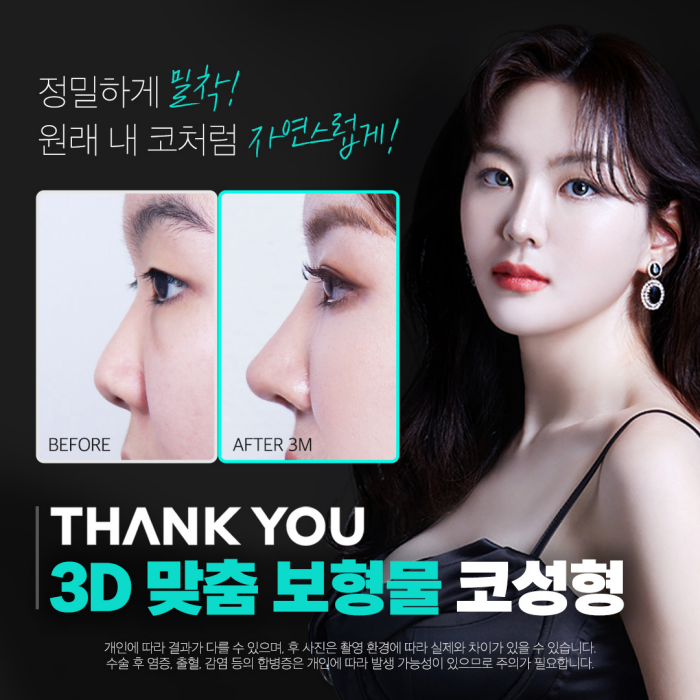 Natural-Looking Rhinoplasty with a Custom Implant That Fits Like My Original Nose! image 1
