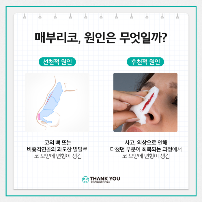 매부리코개선 맞춤 디자인으로 원하던 워너비 코 완성! 관련 이미지 3