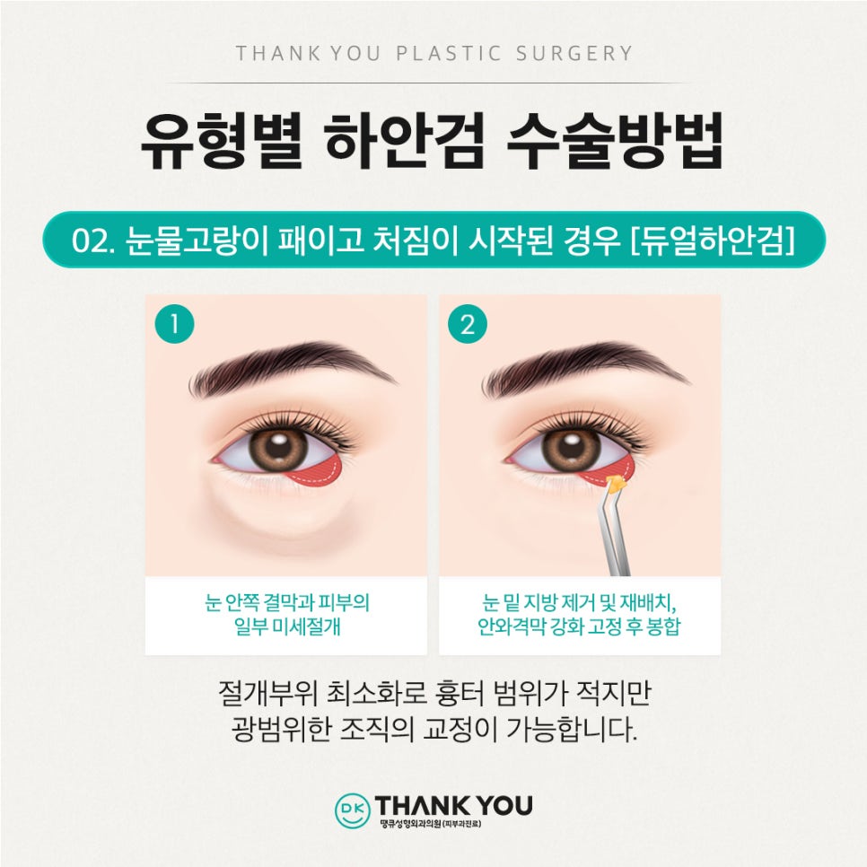 중년눈성형, 하안검수술비용 알아보기 전 이것만은 알고 가세요 관련 이미지 11