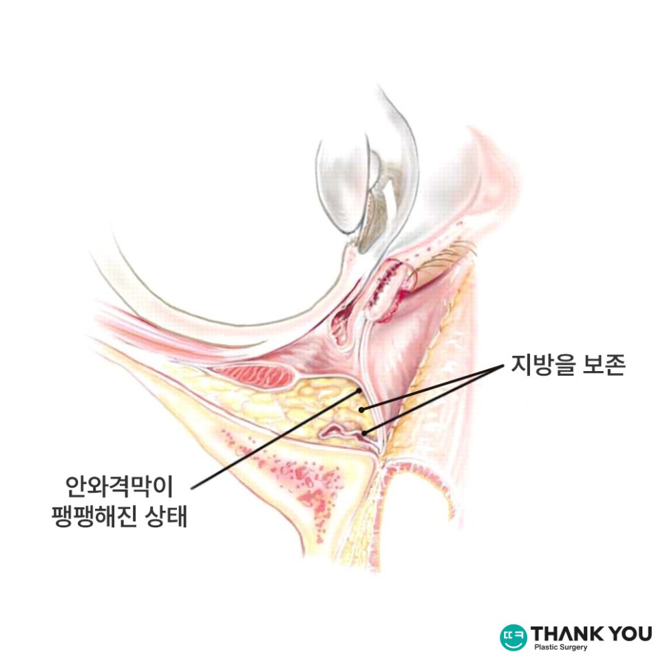 눈밑성형에 격막 강화란 무엇인가요? [눈밑지] 관련 이미지 9
