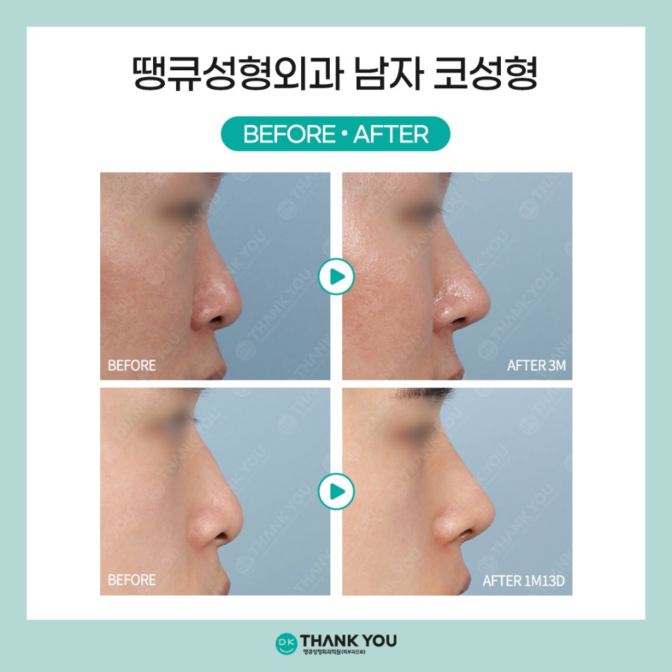 [남자코수술 전후] 코성형외과는 왜 땡큐일까?! 관련 이미지 4