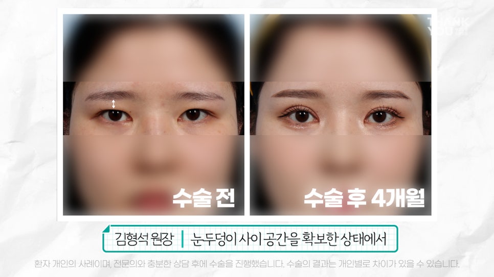 눈재수술 할 때 이마거상 추천하는 이유는? (눈썹올림술 전후) 관련 이미지 17