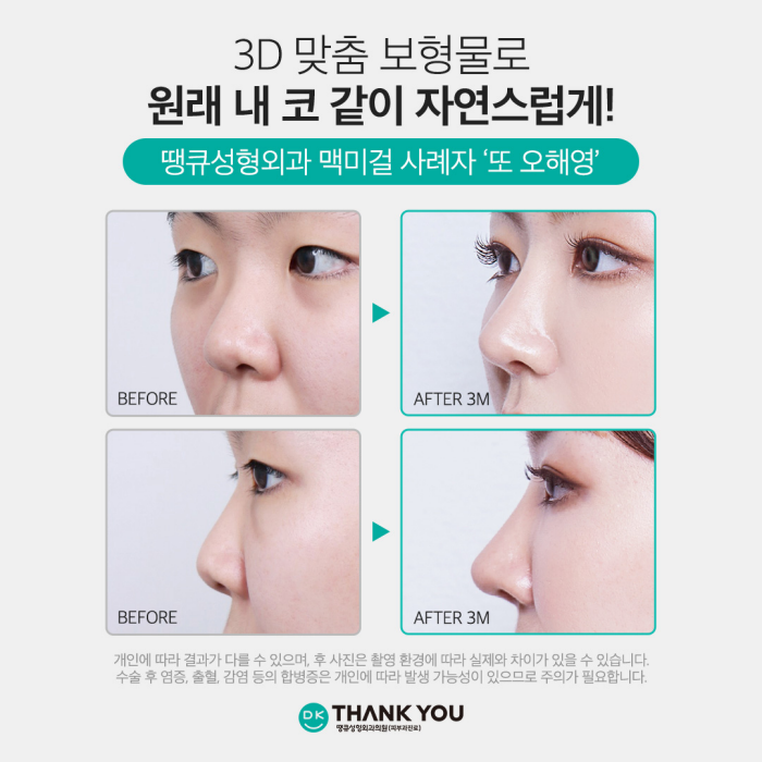 Natural-Looking Rhinoplasty with a Custom Implant That Fits Like My Original Nose! image 5