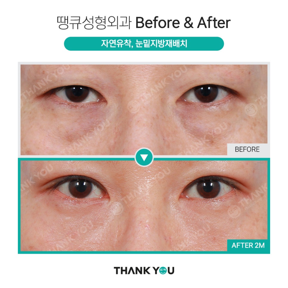하안검과 눈밑지방재배치의 차이점? 관련 이미지 16