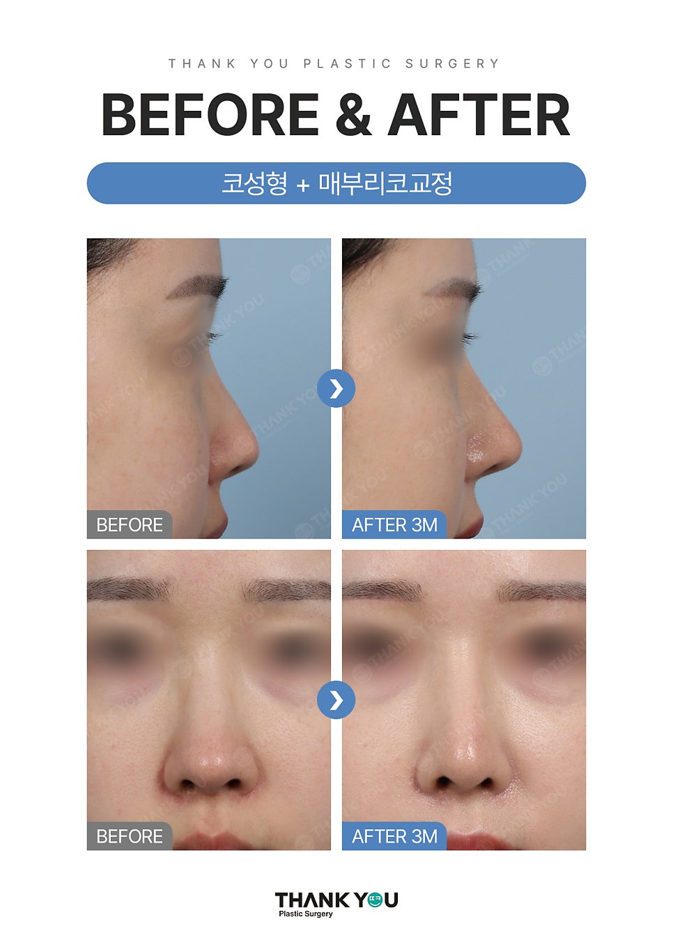 자가늑연골? 기증늑연골? 코성형수술 재료의 끝판왕? 관련 이미지 10