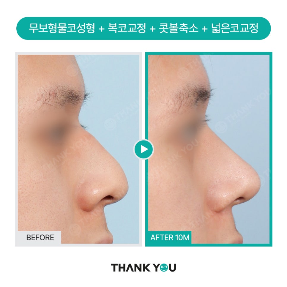 자가늑연골 코수술 장단점, 실리콘없이 무보형물 전후Check 관련 이미지 13