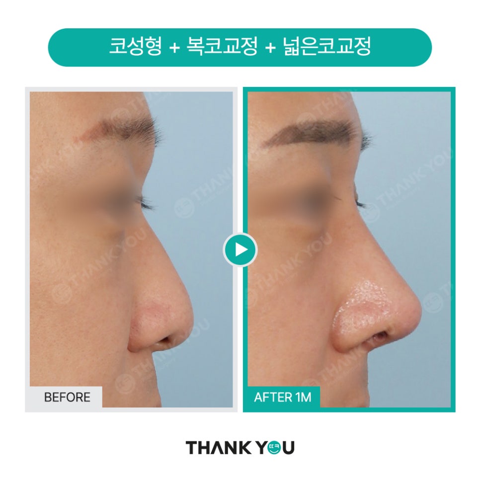 신논현역 성형외과, 남자 휜코성형, 매부리코 성공 포인트는? 관련 이미지 18