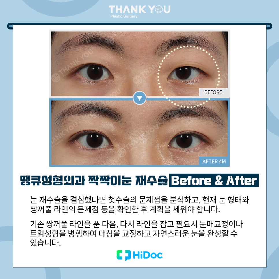 강남 눈재수술, 짝짝이눈 교정 방법 라인 대칭 성공 포인트 관련 이미지 3