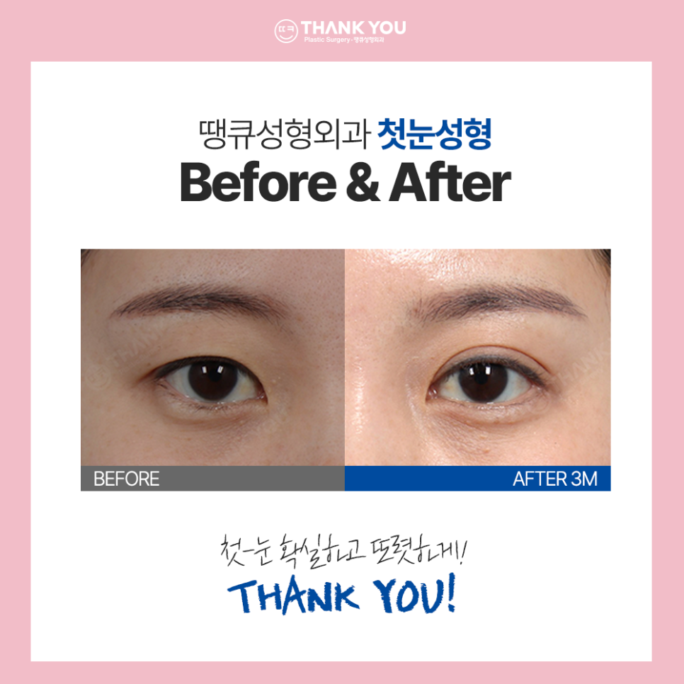수능 끝나면 수험생 버킷리스트? 수험생 눈코 성형 전후Check 관련 이미지 5