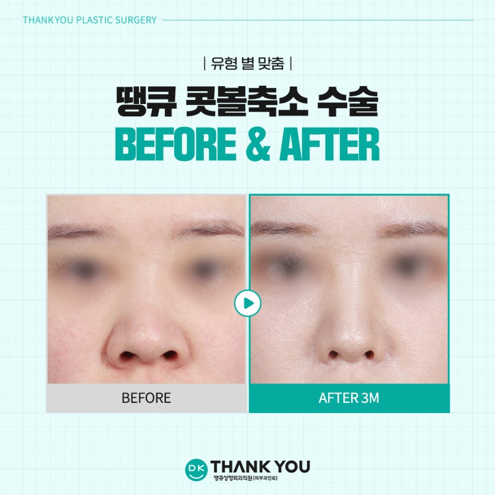 Rhinoplasty Before and After? See the Stylish Nose Created at Thank You Here! image 11