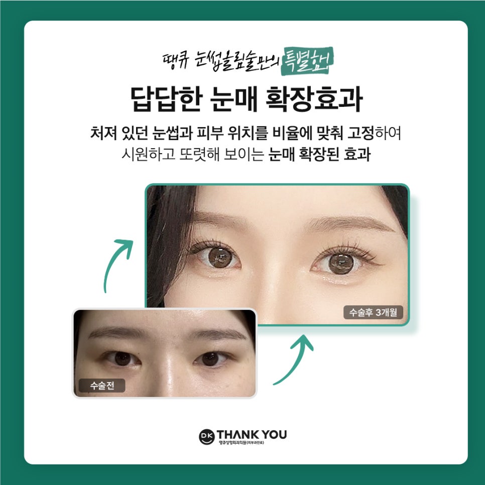 Improving Drooping, Tired-Looking Eyes in One Go with Forehead Lift Surgery! image 9