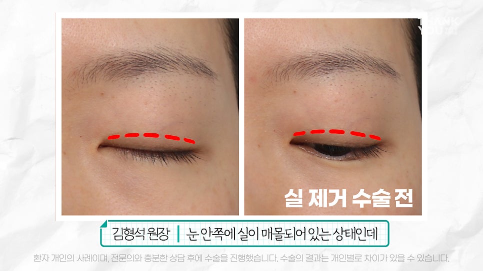 '쌍꺼풀 실 눈찌름'으로 안과? 쌍수실 제거+자연유착 라인 살리는 법 관련 이미지 5