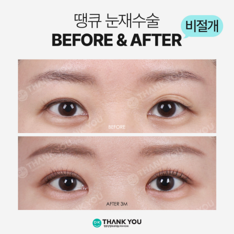 Selection Criteria for Incisional or Non-Incisional Surgery, as Explained by a Specialist in Revision Eyelid Surgery image 10