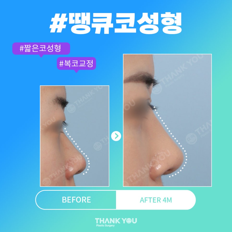 코성형 전후, 코모양 신논현역 성형외과에서 체크 관련 이미지 6