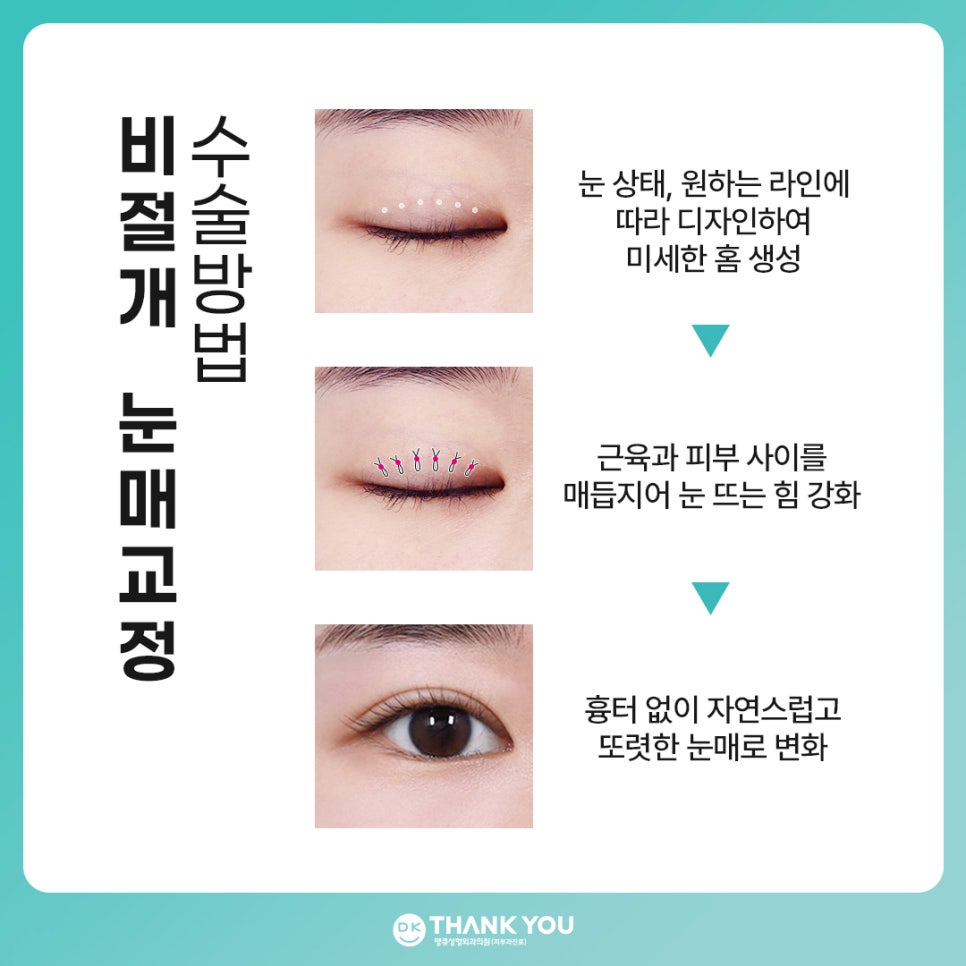 비절개 눈매교정 vs 절개 눈매교정 뭐가 다를까? 관련 이미지 7