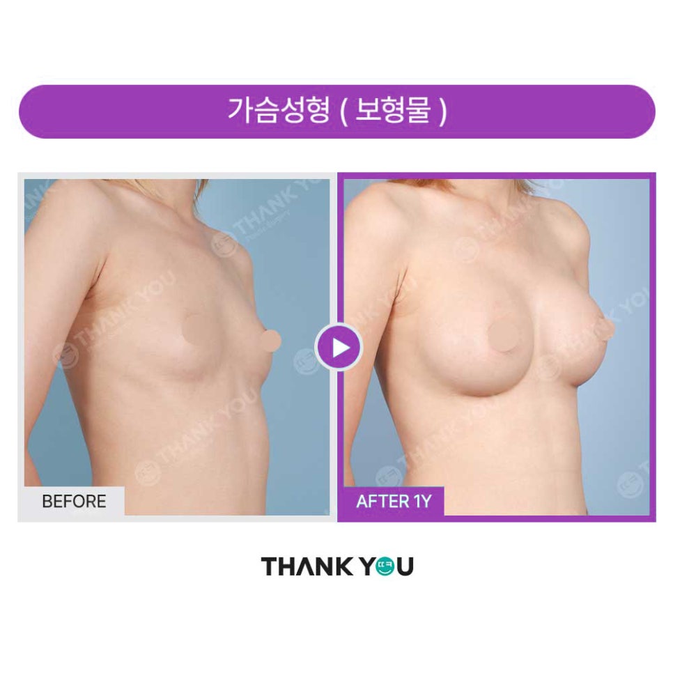 강남 가슴성형외과, 흉곽과 체형을 고려한 모티바보형물 관련 이미지 18