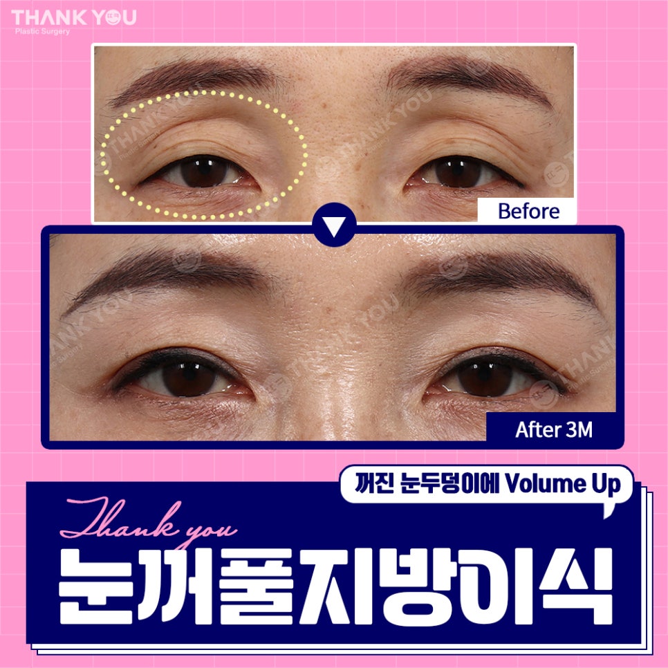눈꺼짐? Thank You눈꺼풀 지방이식으로 볼륨UP 관련 이미지 8