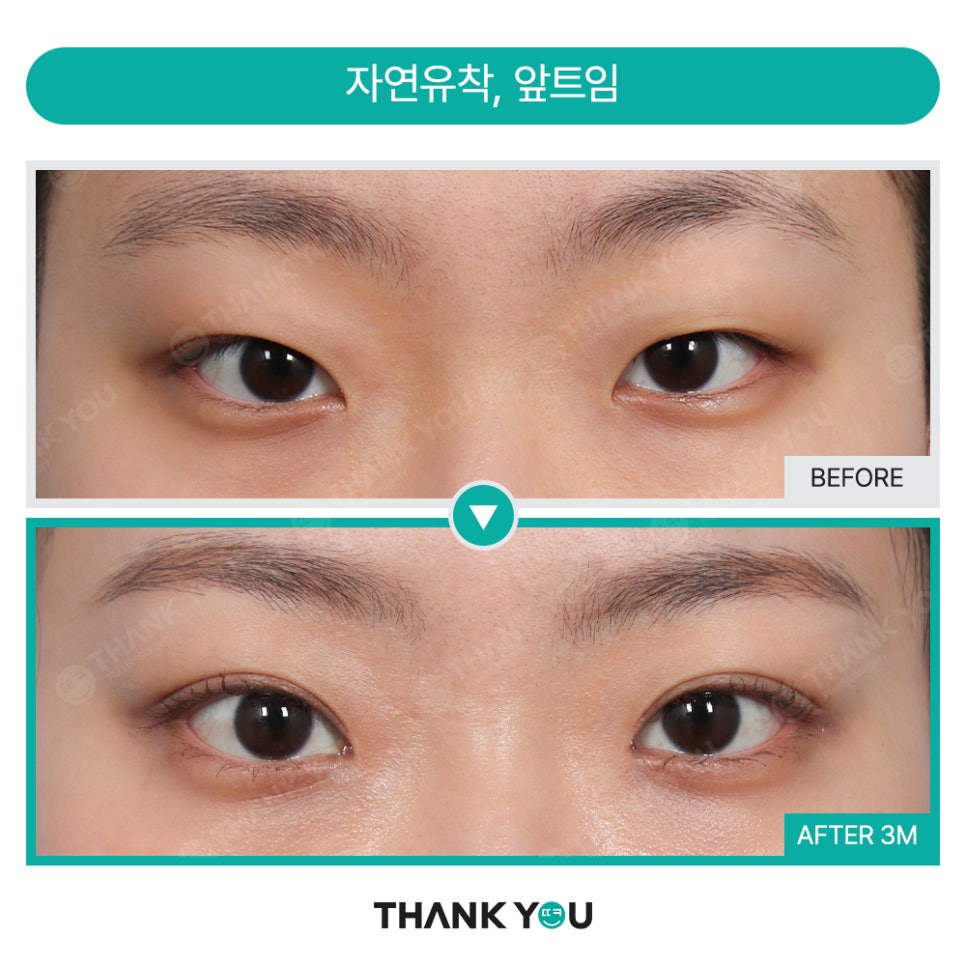 [비절개눈매교정+앞윗트임+눈밑지] 자고 일어났을 뿐인데 제니가?! 관련 이미지 18
