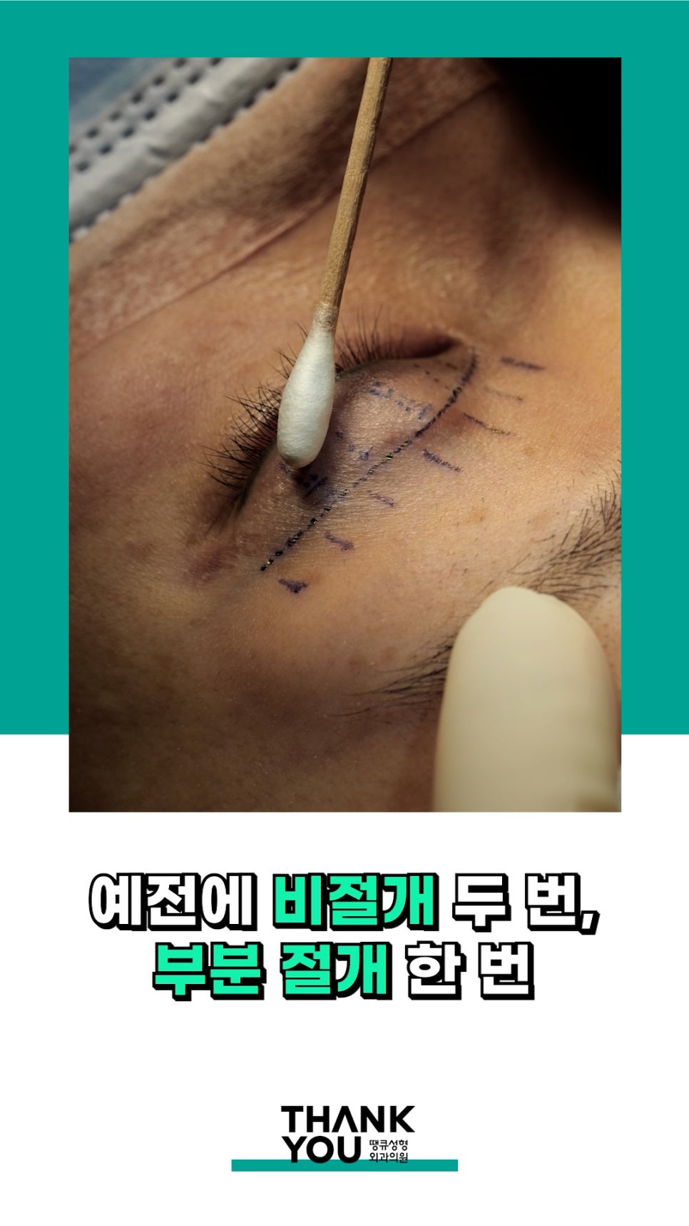 3번 눈재수술? 근데 실제거를 안했다고? 땡큐에서 전부 실제거! 관련 이미지 3