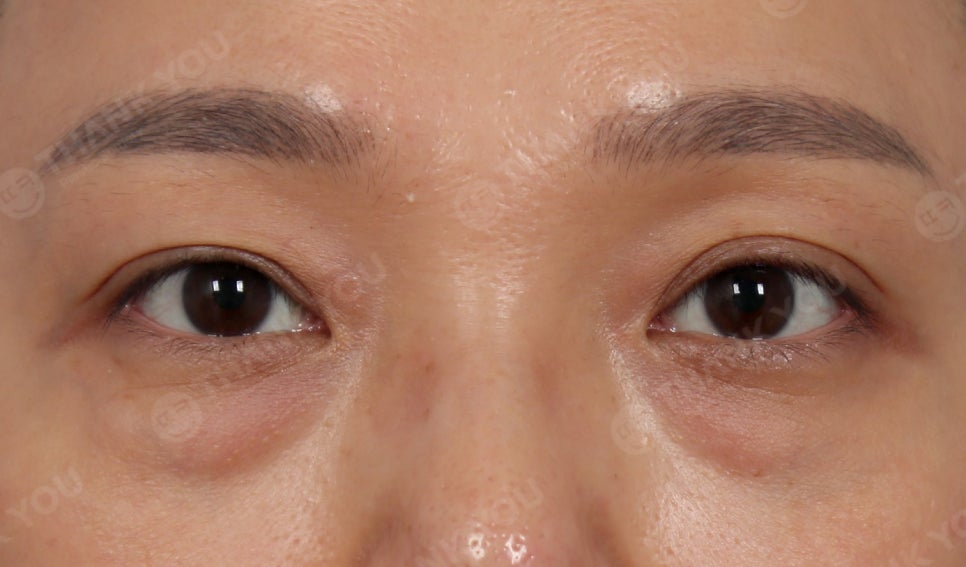 눈밑지방재배치 앞광대 지방이식이 필요한 이유? 관련 이미지 5