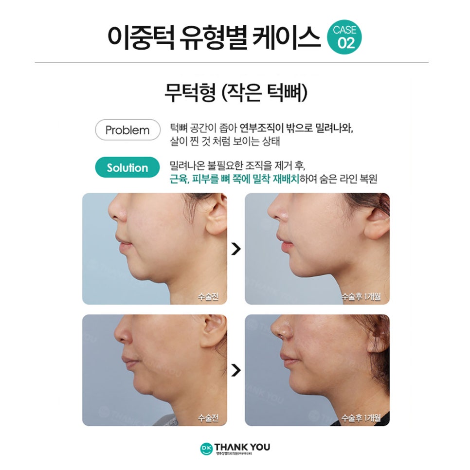 Not Enough Improvement from Chin Liposuction Alone? How About Thank You Double Chin Removal Surgery?! image 8
