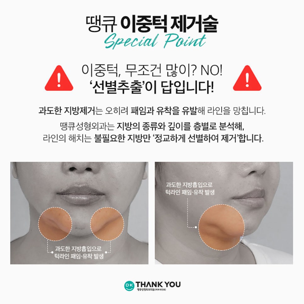 Not Enough Improvement from Chin Liposuction Alone? How About Thank You Double Chin Removal Surgery?! image 10