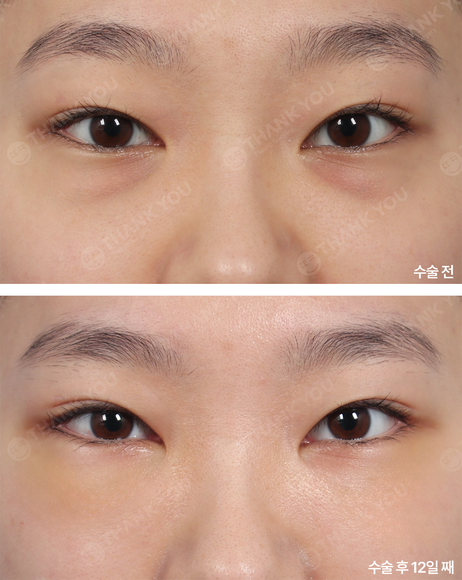 눈밑 필러 넣었는데 눈밑지방재배치 가능할까요? (이호준 칼럼) 관련 이미지 10