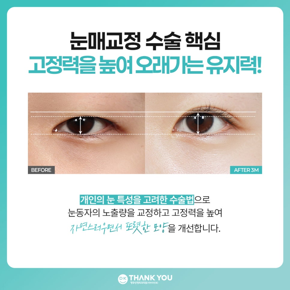 비절개 눈매교정 vs 절개 눈매교정 뭐가 다를까? 관련 이미지 8