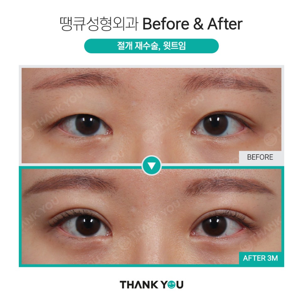 강남쌍수 절개눈매교정 전후와 트임성형 추천 POINT 관련 이미지 4