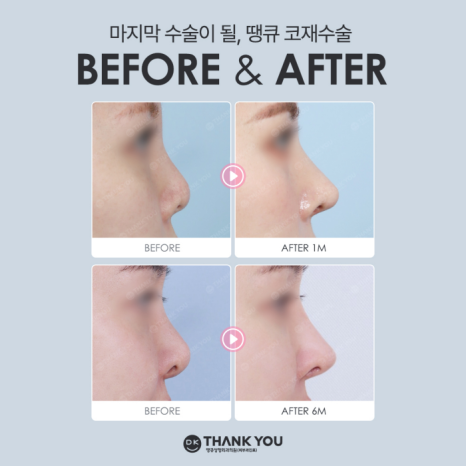 코재수술잘하는병원 땡큐 이벤트✨ 관련 이미지 12