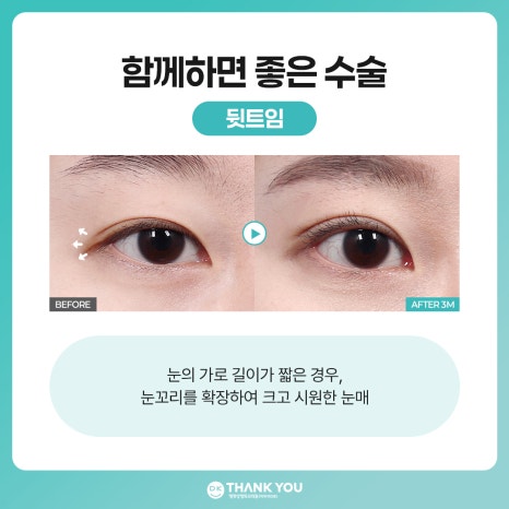 비절개 눈매교정 vs 절개 눈매교정 뭐가 다를까? 관련 이미지 12