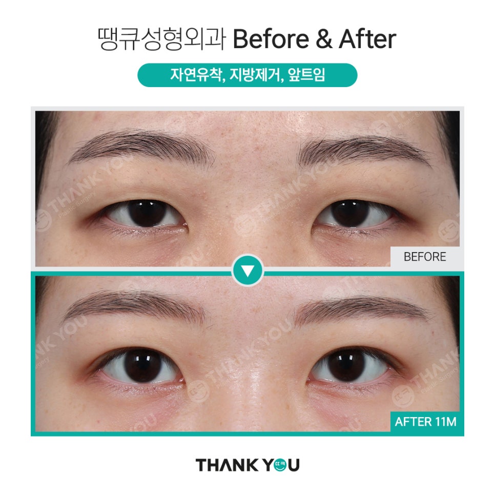 쌍수 뒷트임 (앞트임,밑트임, 듀얼트임 종류) 전후사진 관련 이미지 6