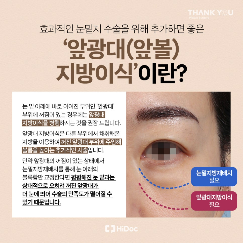눈밑지 지방이식? 앞광대지방이식 필요한 이유? 관련 이미지 16
