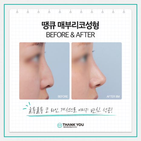 매부리코개선 맞춤 디자인으로 원하던 워너비 코 완성! 관련 이미지 10